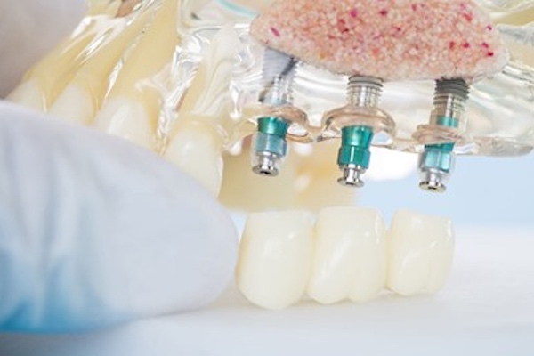 Dental Implants